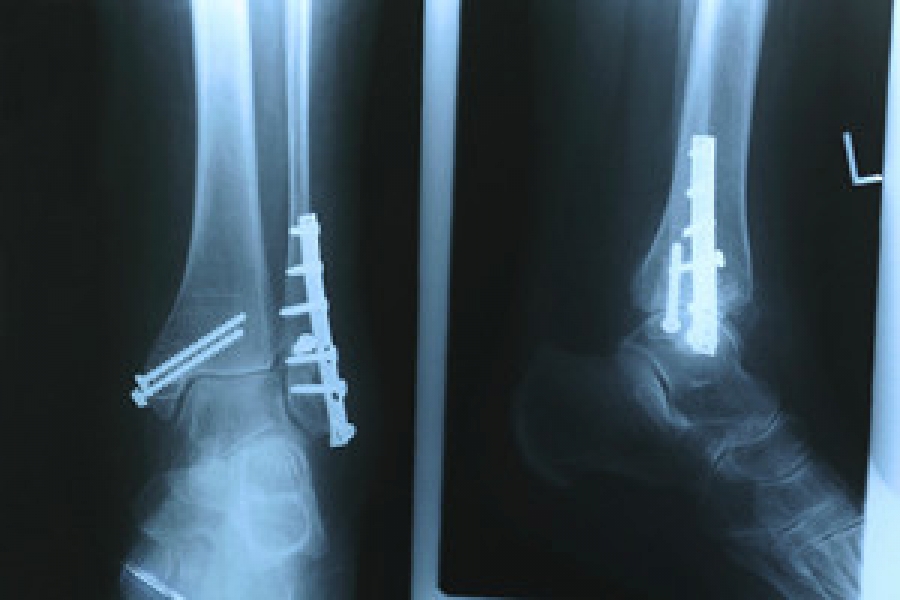 what-are-the-different-types-of-fractures